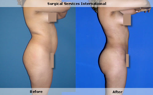 Liposuction, fat grafting buttocks